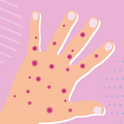 Malattie infettive Real Time PCR Monkeypox Test Kit MPXV Registrato CE 1 test/scatola
